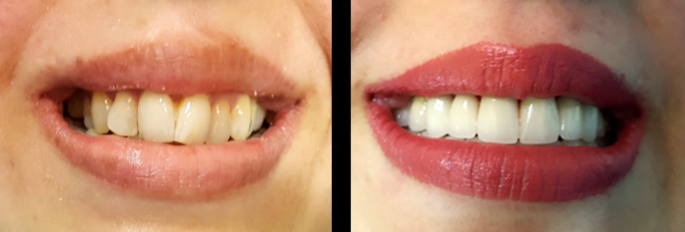 Before and after smile transformation with E-max veneers — before