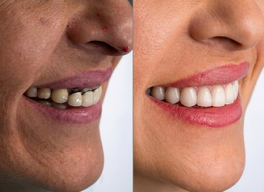 Profile view before and after veneer treatment — before