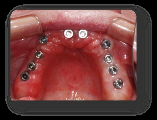 Full-arch dental implant abutments placed in the upper jaw