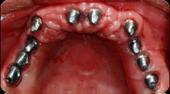Dental implant rehabilitation clinical result
