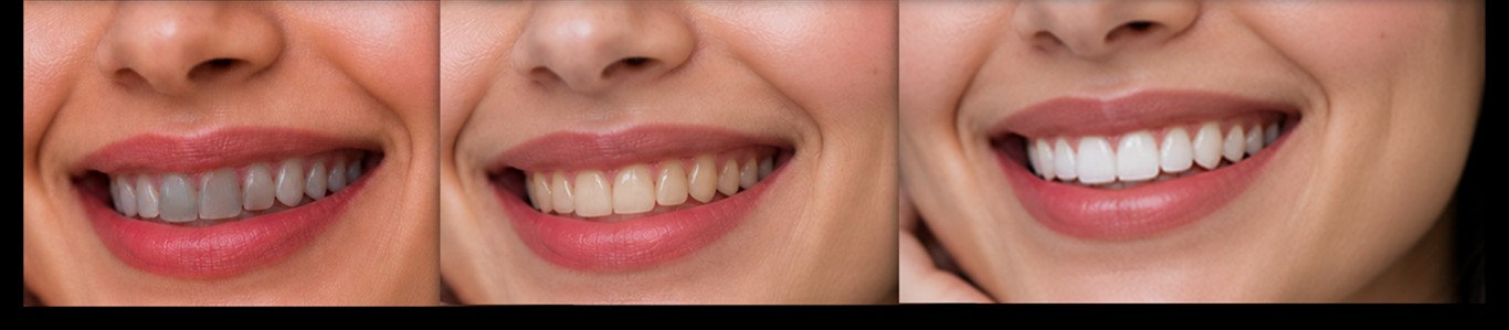 Three-stage smile brightening and veneer progression — before