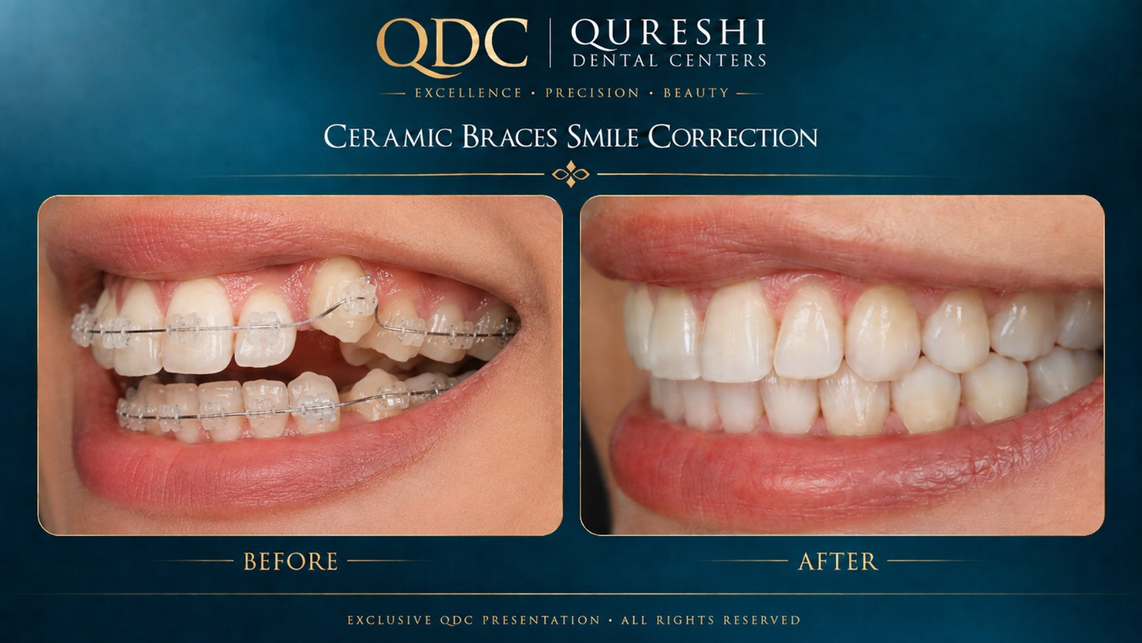 Ceramic braces before and after orthodontic treatment