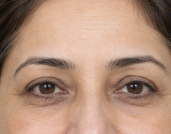 Forehead & Eye Area before and after — after