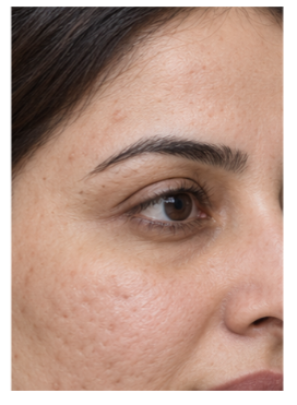 Acne Scars & Texture before and after — after