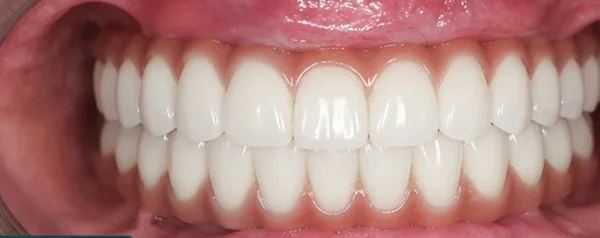 All-on-4 — four implants, one life-changing smile — after