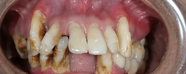 All-on-4 — four implants, one life-changing smile — before