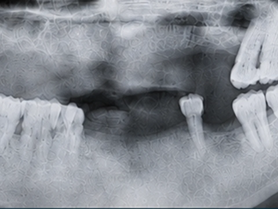 Full-arch reconstruction — X-ray — before