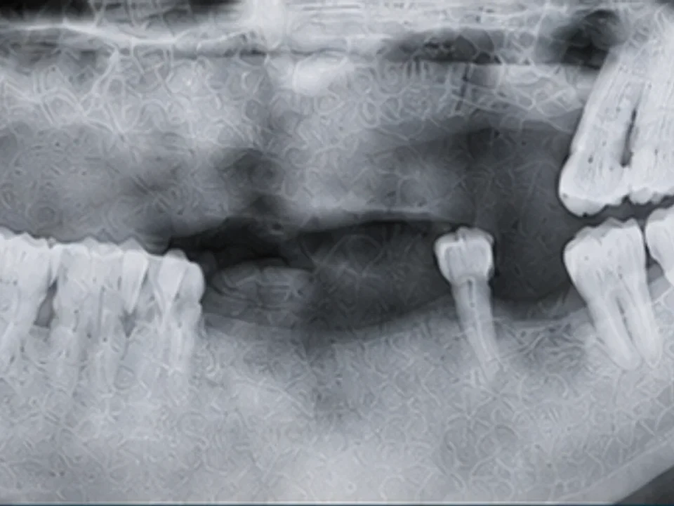 Full-arch reconstruction — X-ray — before