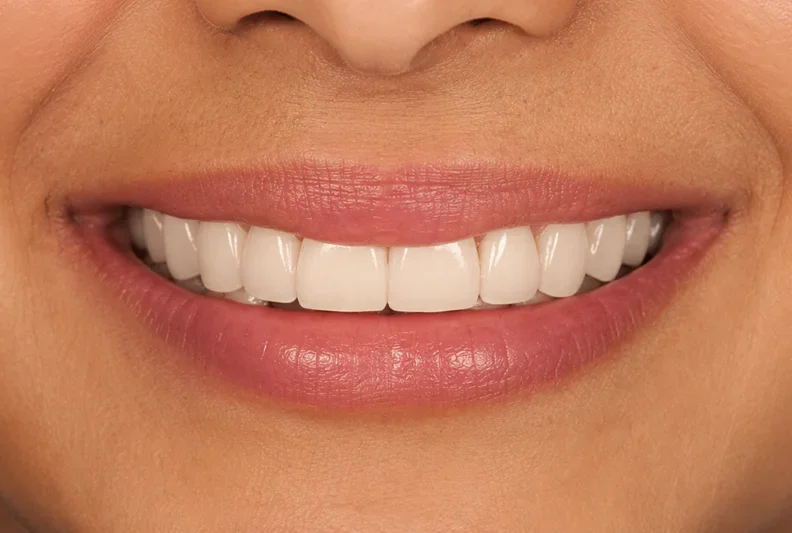 Dental bridge fills the gap — after