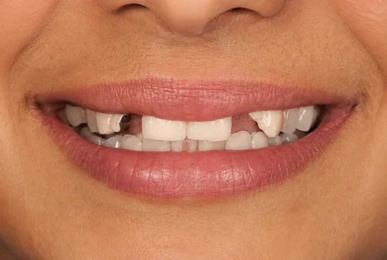 Dental bridge fills the gap — before