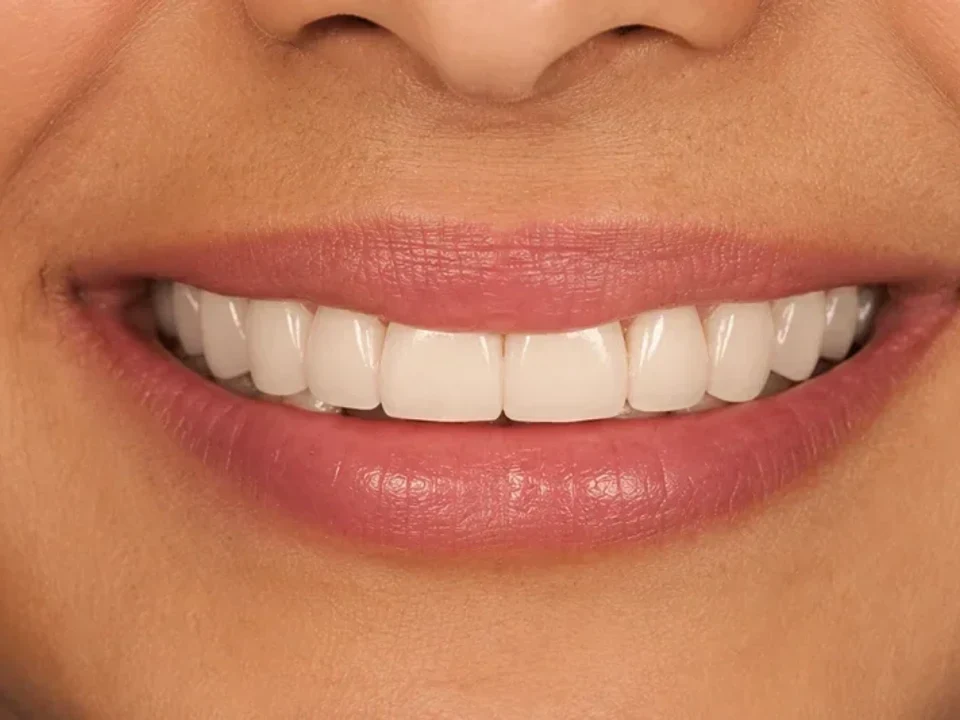 Dental bridge fills the gap — after
