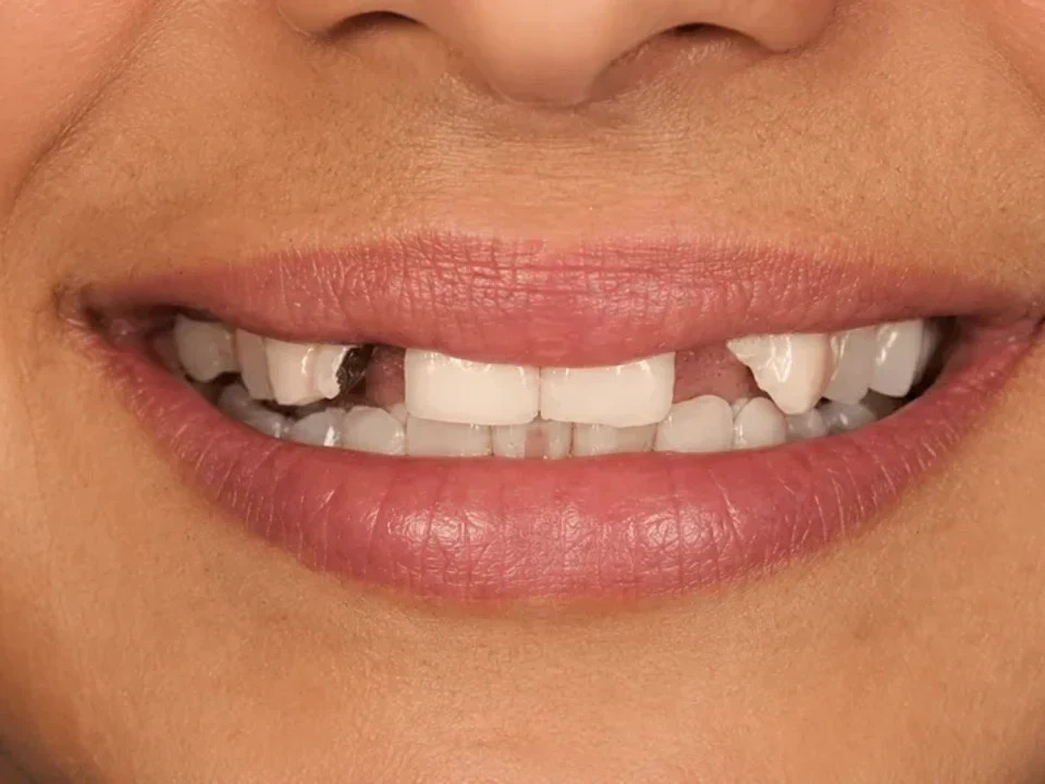 Dental bridge fills the gap — before