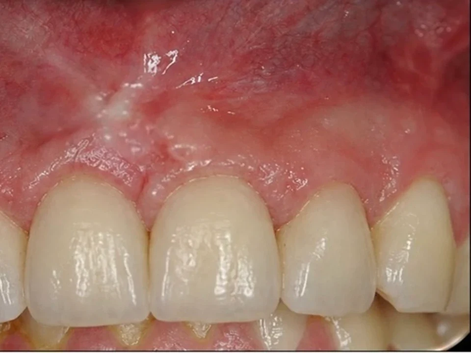 Bone loss rebuilt to restore support for implants — after
