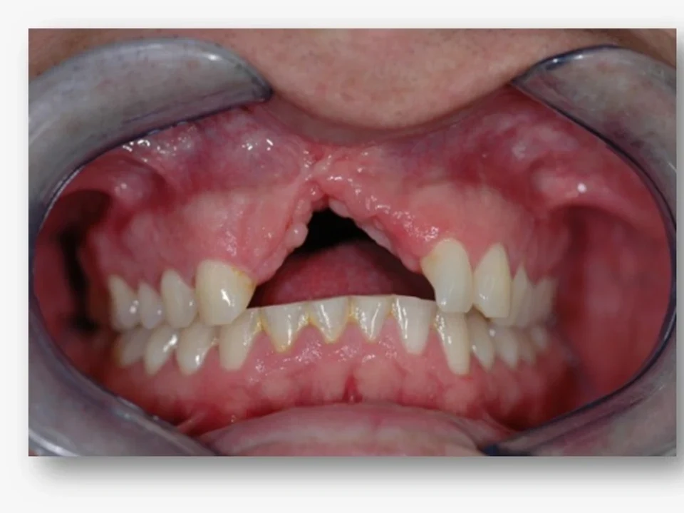 Bone loss rebuilt to restore support for implants — before