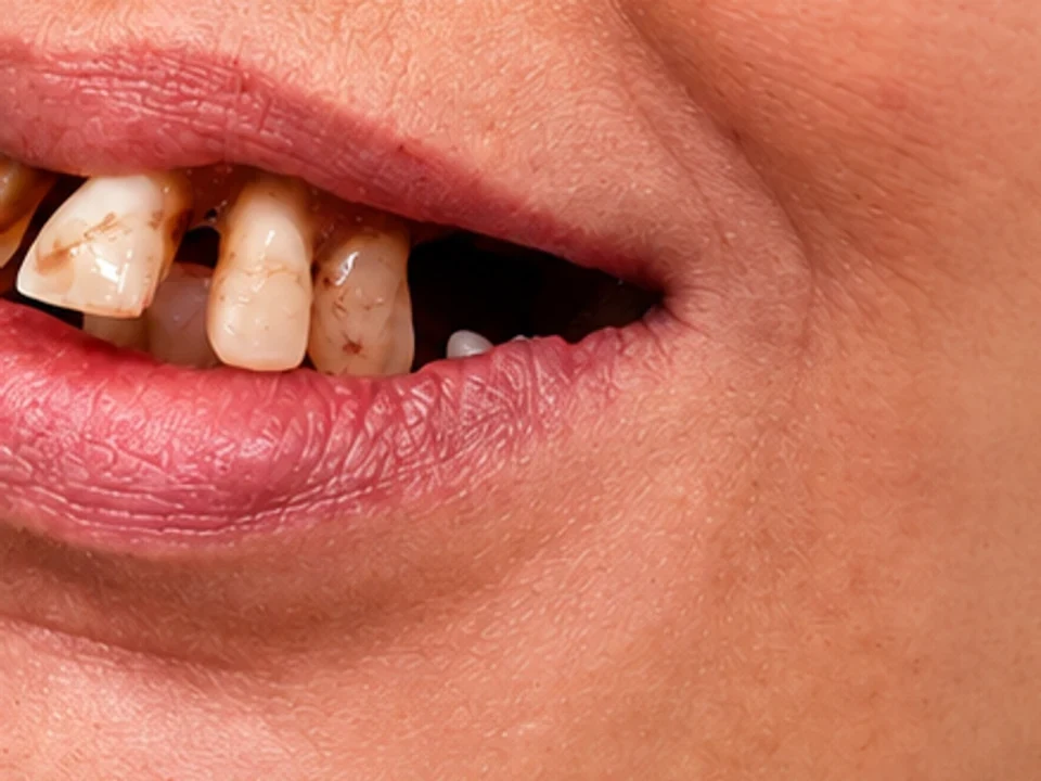 Full-mouth rehabilitation — final restored smile — before