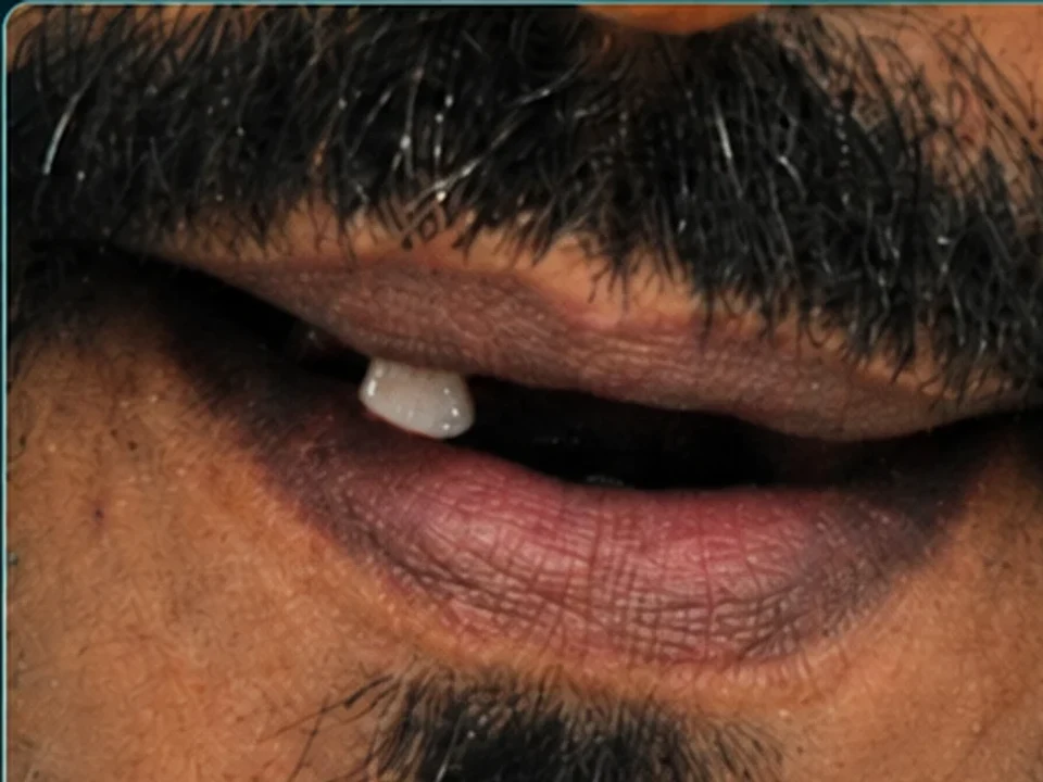 Missing teeth replaced — tooth loss to restored smile — before