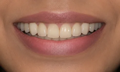 Aesthetic crowns — before and after — after