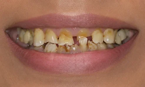 Aesthetic crowns — before and after — before