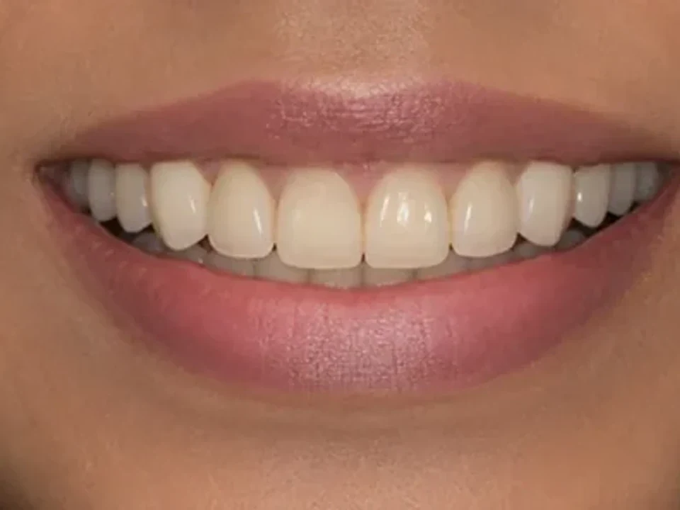 Aesthetic crowns — before and after — after