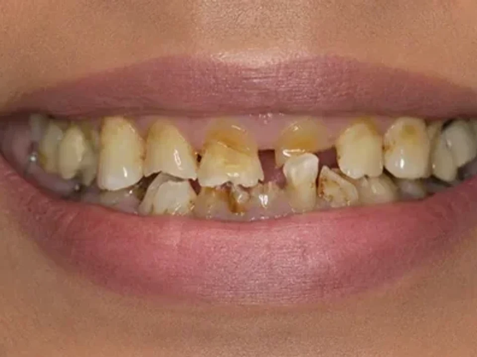 Aesthetic crowns — before and after — before