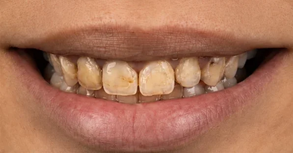 Stained teeth restored with crowns — before