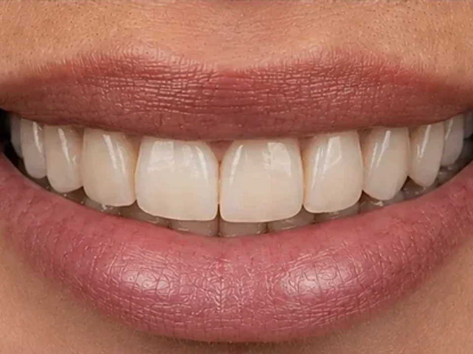 Stained teeth restored with crowns — after