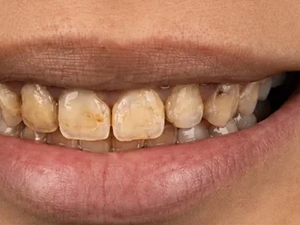 Stained teeth restored with crowns — before