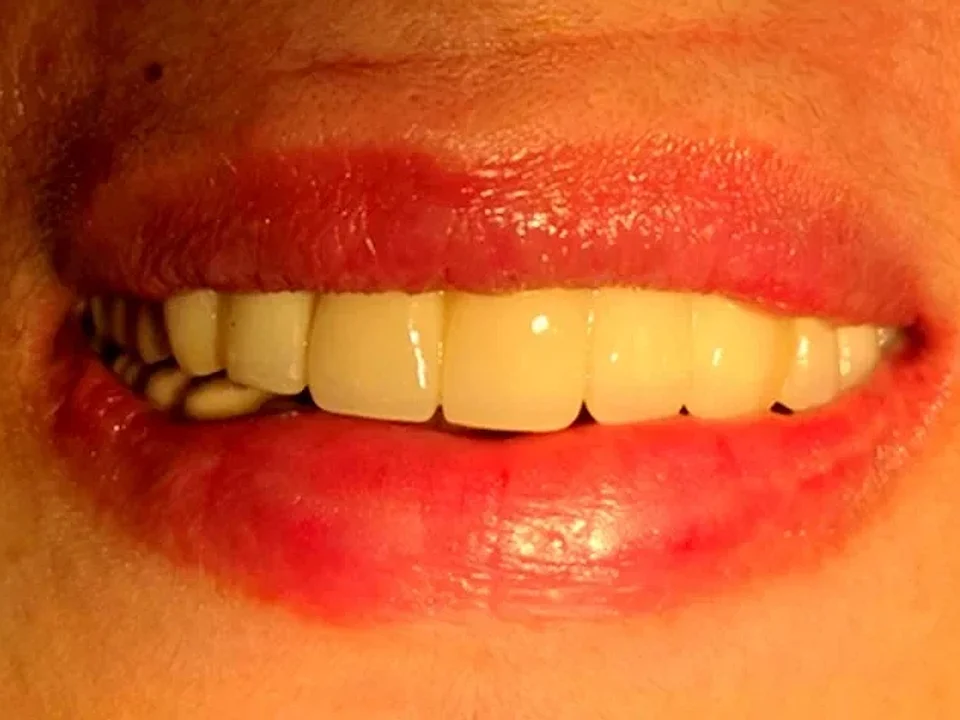 Gapped front teeth restored with crowns — after