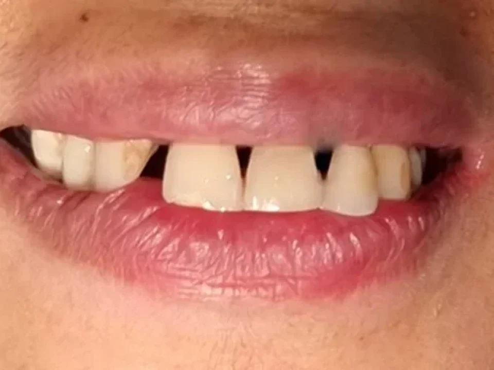 Gapped front teeth restored with crowns — before