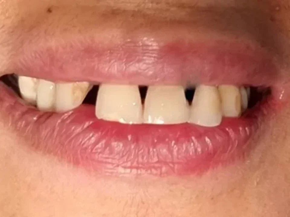 Gapped front teeth restored with crowns — before