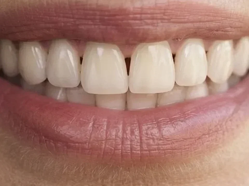Damaged teeth restored to a lasting smile — after
