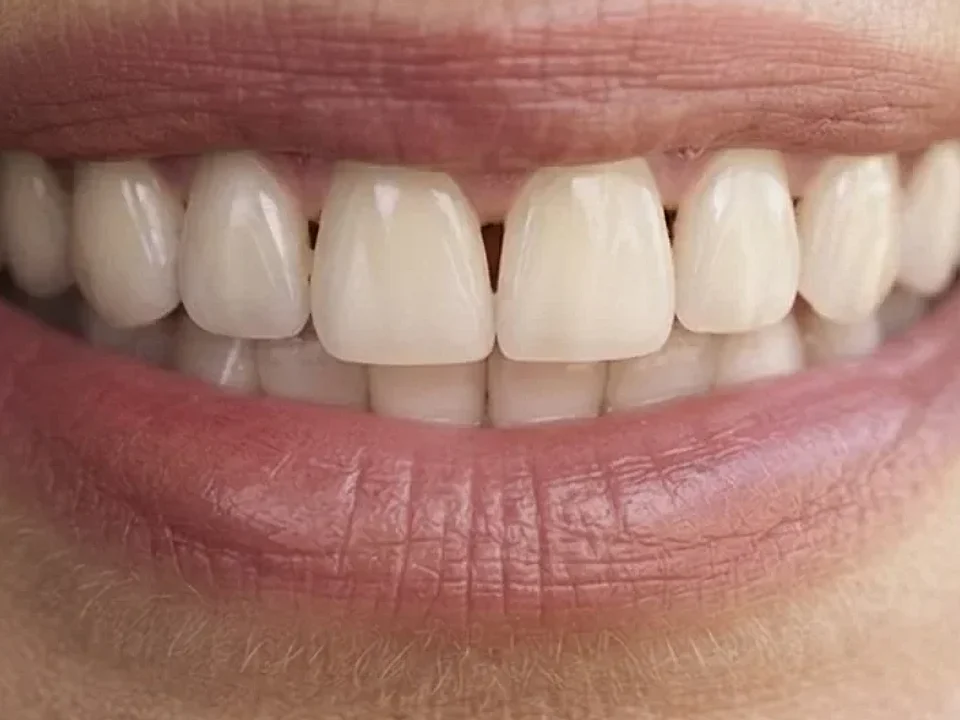 Damaged teeth restored to a lasting smile — after