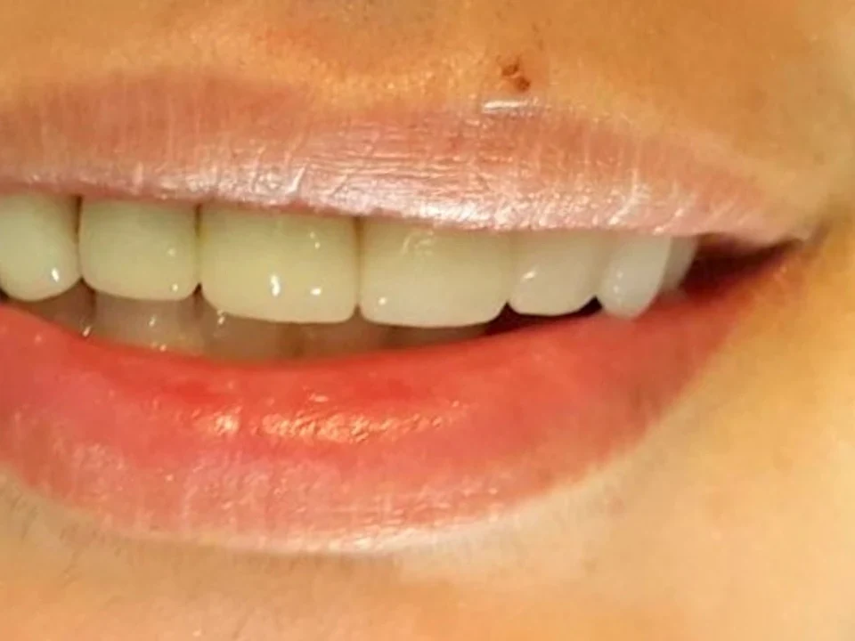Crown placed to cover a dental implant — after