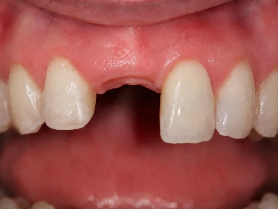 Crown placed to cover a dental implant — before