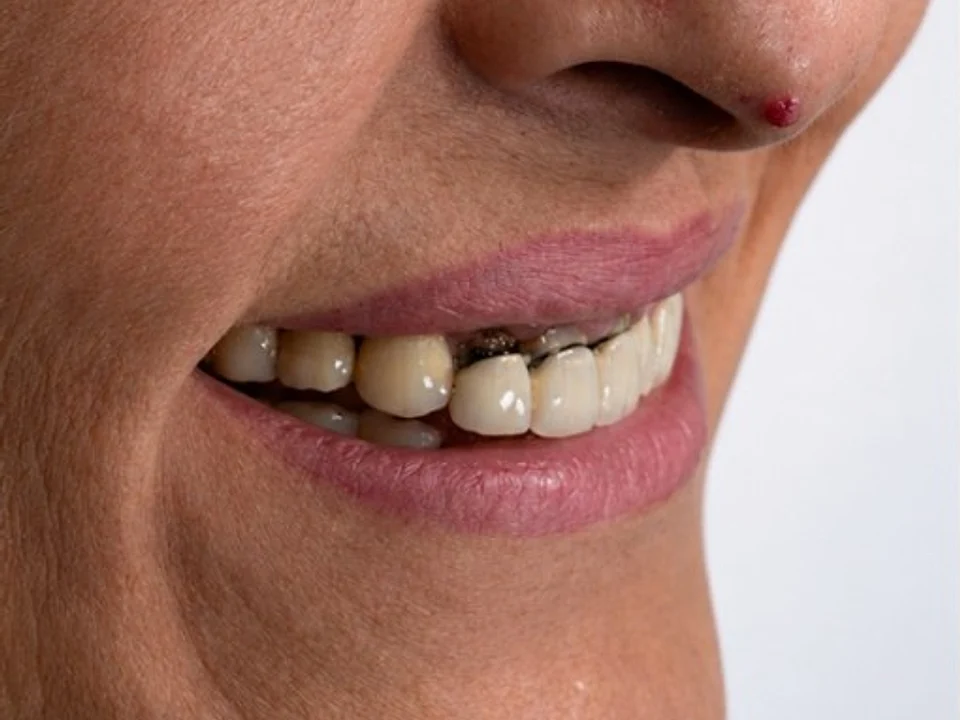 Missing tooth restored — profile smile — before