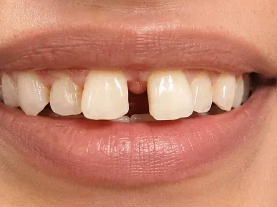 Diastema closed for a continuous smile line — before