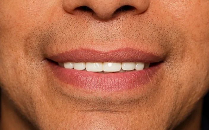 Smile transformation — after