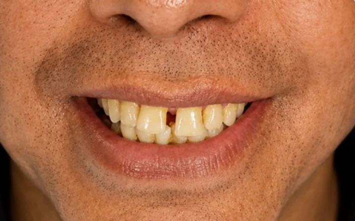 Smile transformation — before