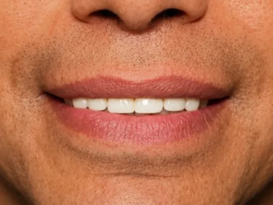 Smile transformation — after