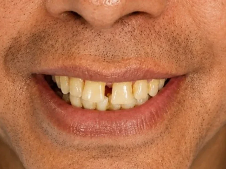 Smile transformation — before