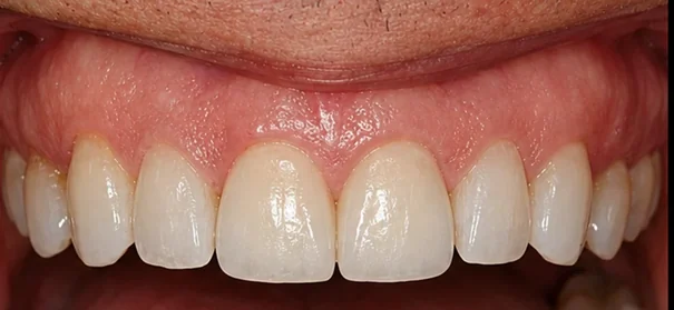Managing diastemas with veneers — after