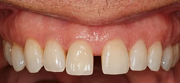 Managing diastemas with veneers — before