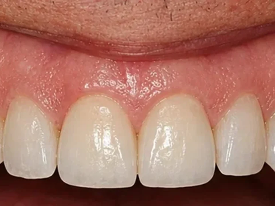 Managing diastemas with veneers — after
