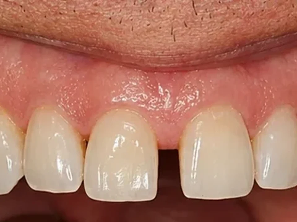 Managing diastemas with veneers — before