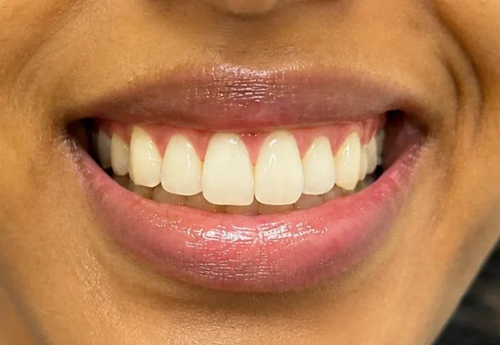 Lip and gum pigmentation — before and after — after
