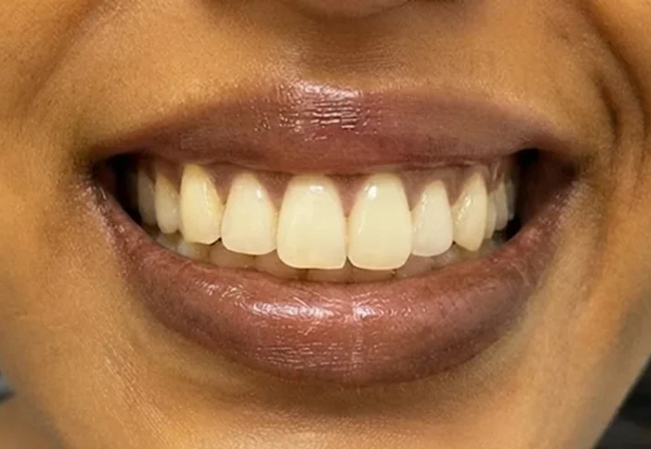 Lip and gum pigmentation — before and after — before