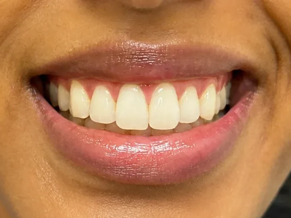 Lip and gum pigmentation — before and after — after
