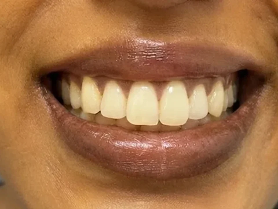 Lip and gum pigmentation — before and after — before