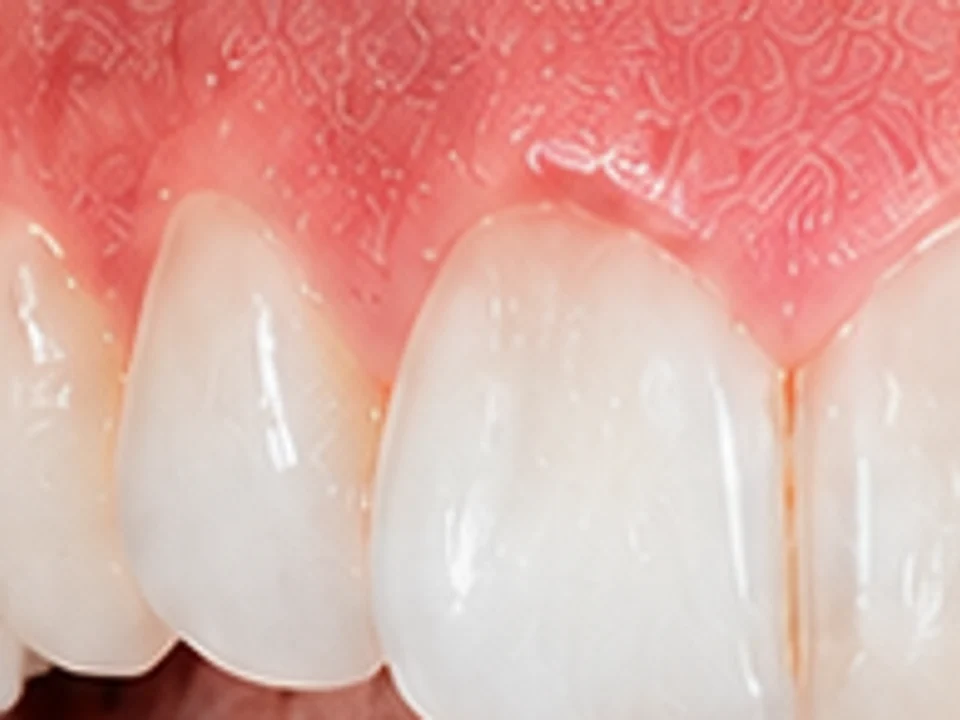 Gum depigmentation — lighter, even pink — after