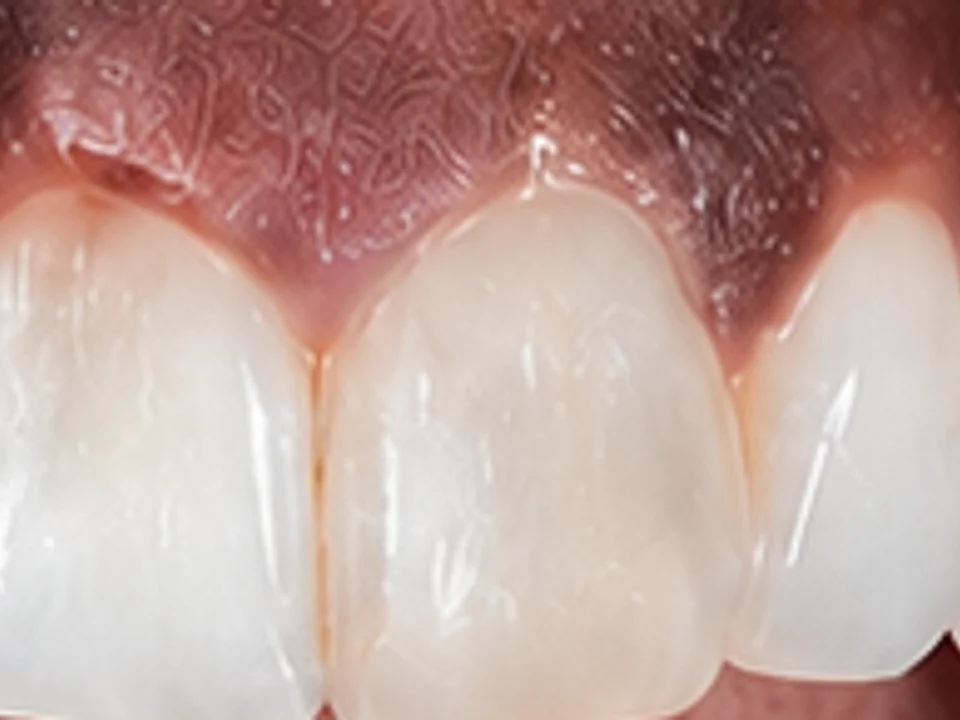 Gum depigmentation — lighter, even pink — before